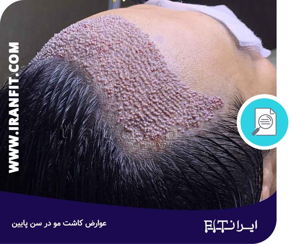 احتمال ریزش مجدد مو؛ یکی از عوارض کاشت مو در سنین پایین