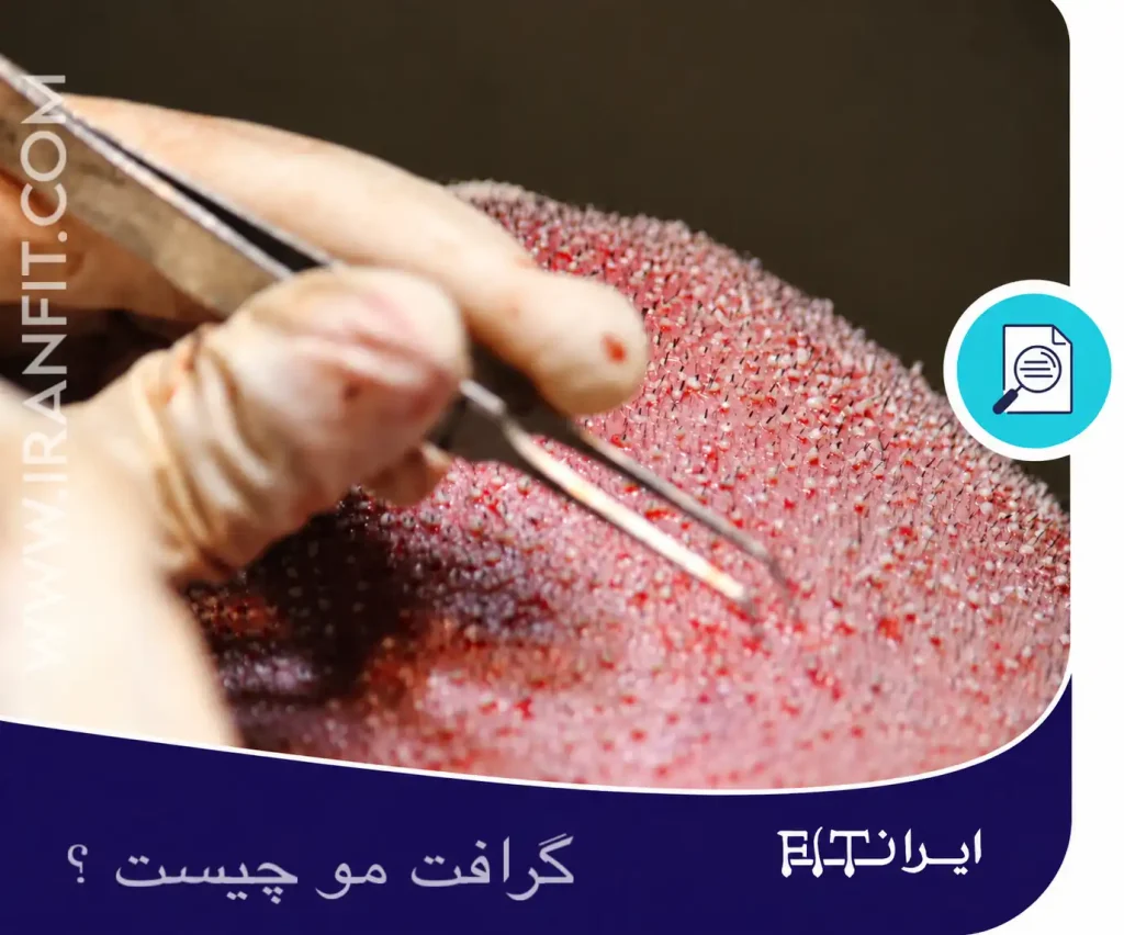 کاشت گرافت مو در حین کاشت مو