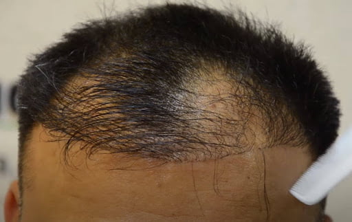 نتایج کاشت مو در مراکز بدون مجوز