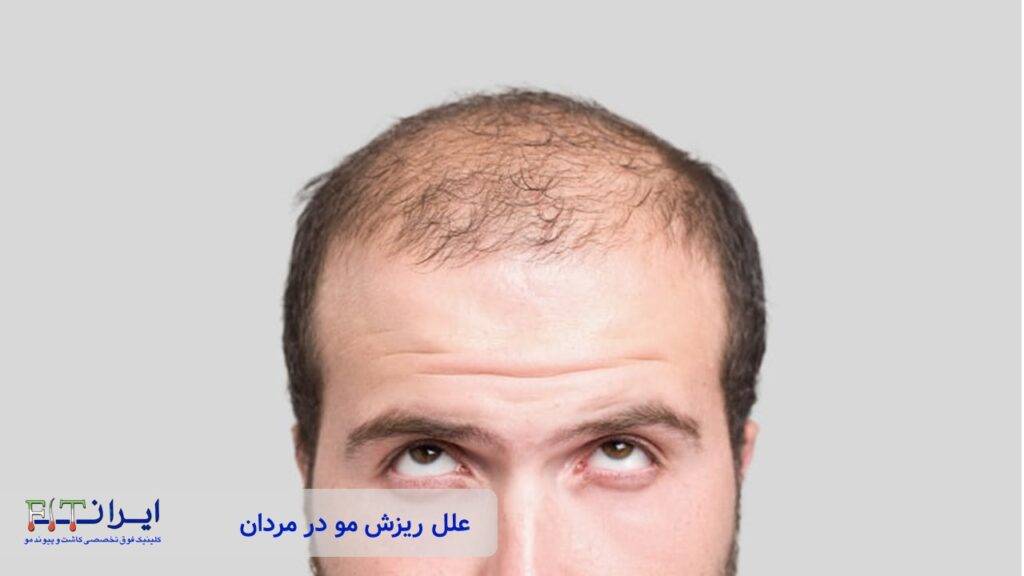 علل ریزش مو مردان