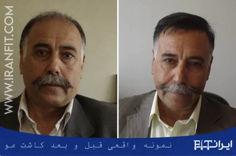 نمونه قبل و بعد کاشت مو