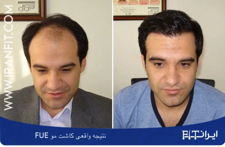 نتیجه کاشت مو FUE در ایرانfit