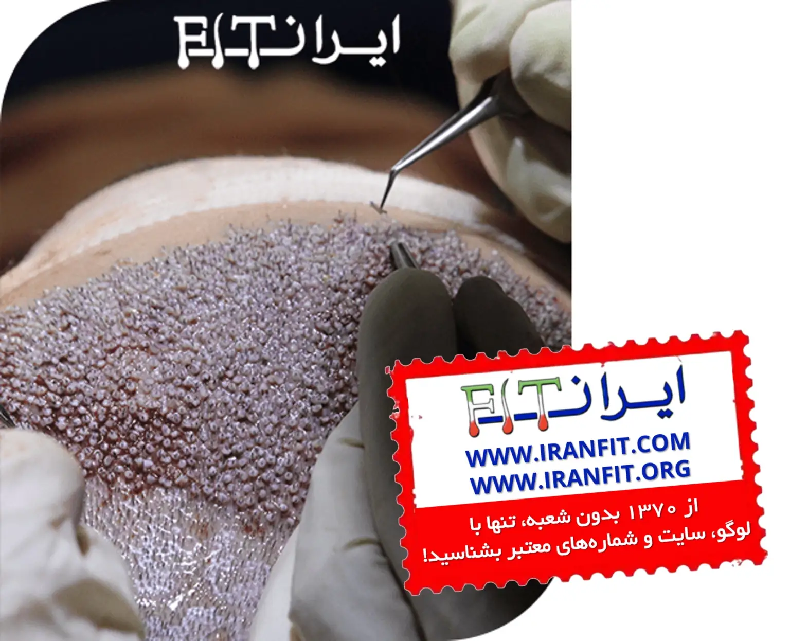 کاشت مو به روش FUE
