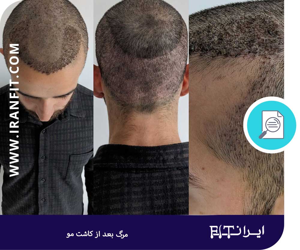 احتمال مرگ پس از کاشت مو