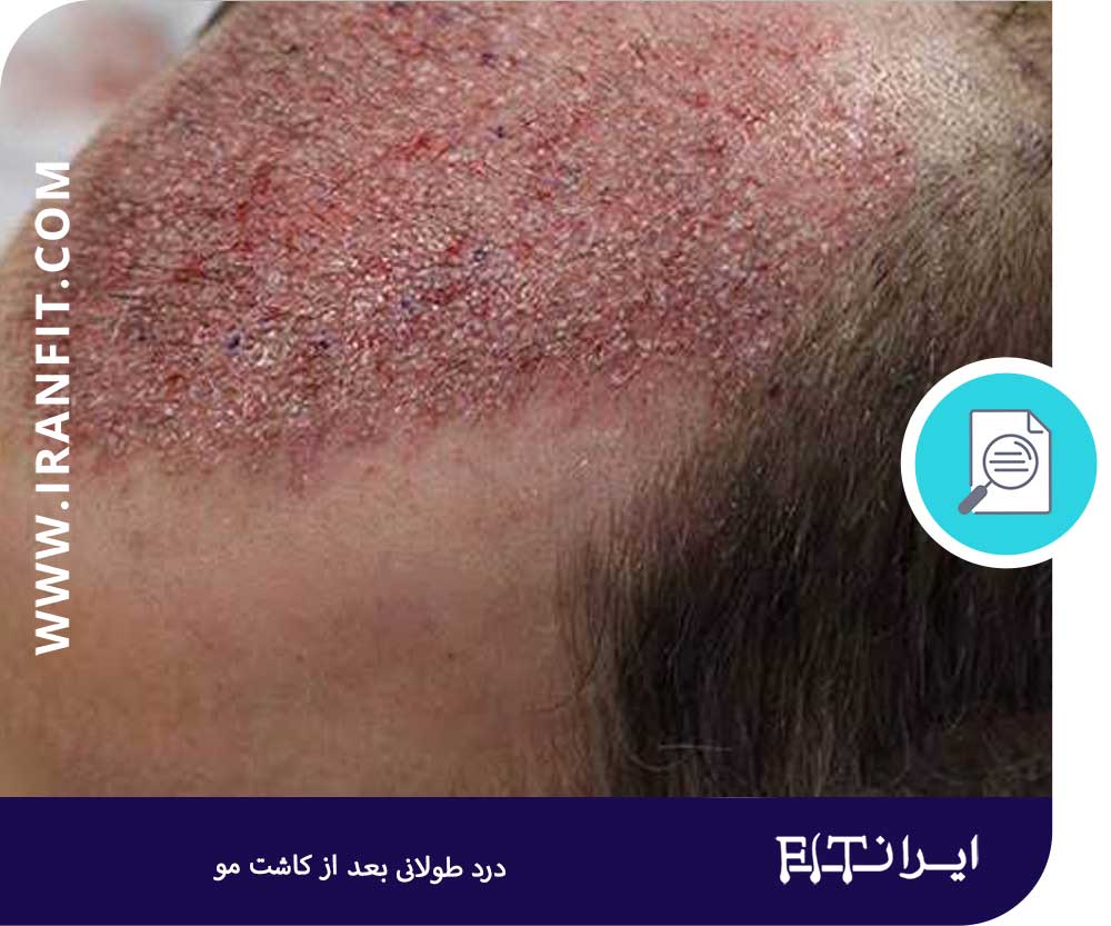 درد شدید بعد از کاشت مو