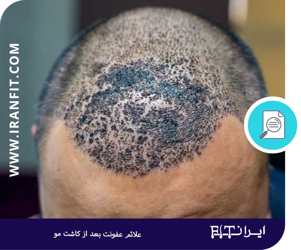علائم عفونت بعد از کاشت مو