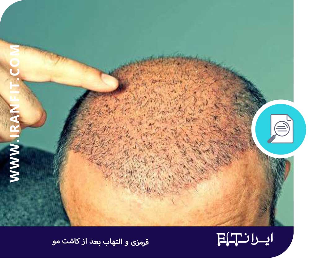 قرمزی و التهاب بعد از کاشت مو