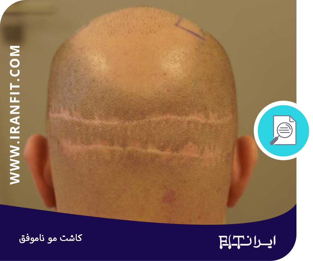 دلایل کاشت موی ناموفق