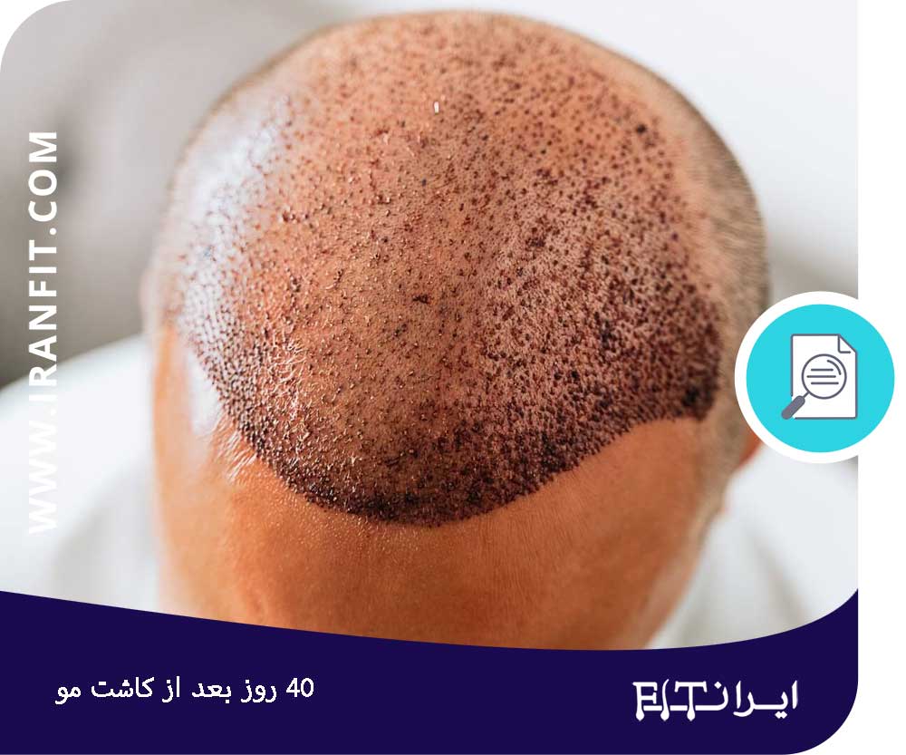 روند رشد مو تا 40 روز پس از کاشت مو