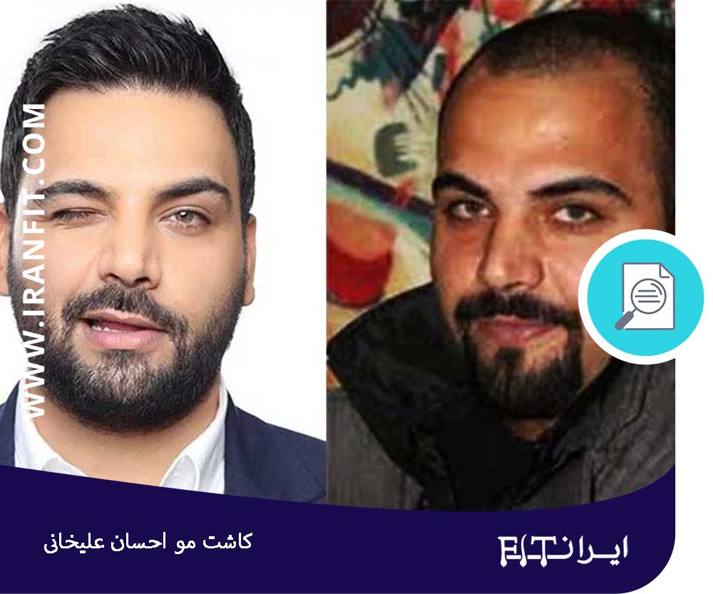 قیمت کاشت مو به سبک علیخانی