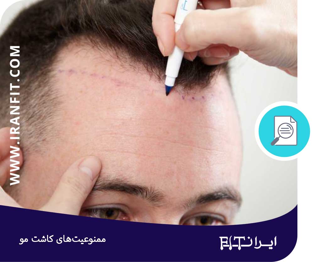 ممنوعیات پس از کاشت مو