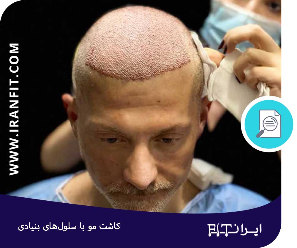 نحوه کاشت مو با روش سلول‌های بنیادی