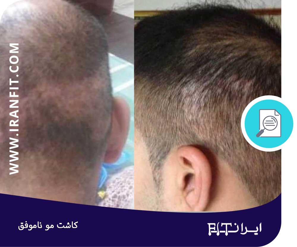 نشانه‌های کاشت موی موفق