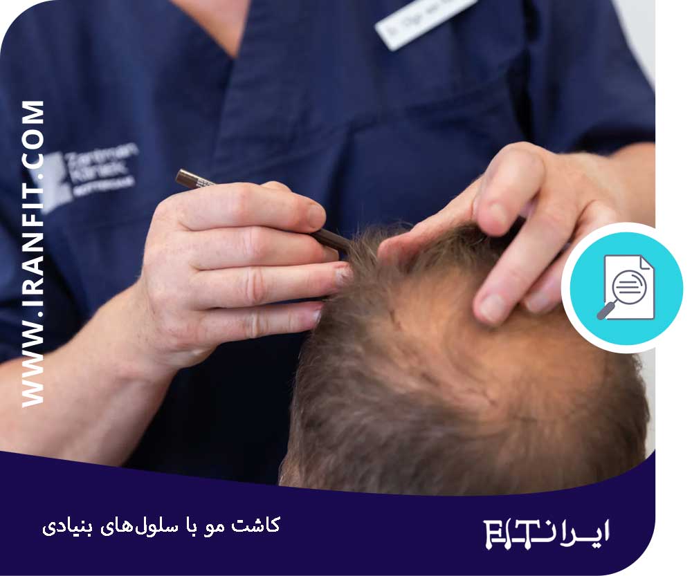 هزینه کاشت مو با سلول بنیادی