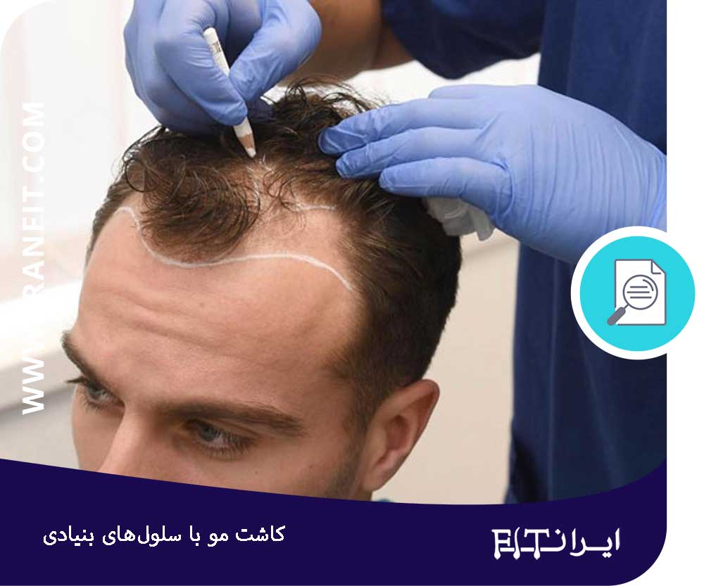 کاشت مو با سلول بنیادی