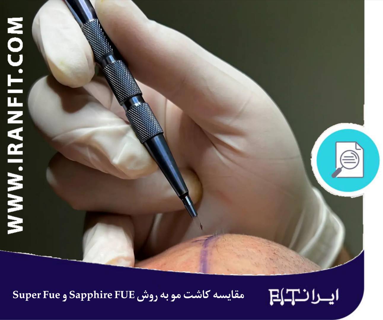 کاشت مو به روش SapphireFUE و SuperFUE
