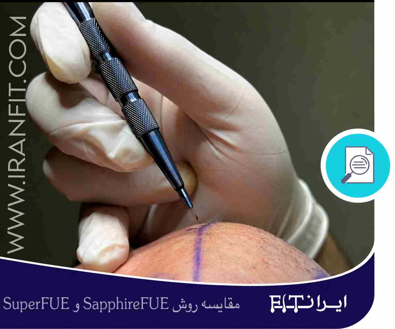 مقایسه کاشت مو به روش SapphireFUE و SuperFUE