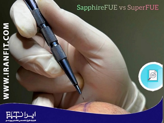 تفاوت کاشت مو به روش SapphireFUE و SuperFUE