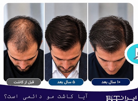 کاشت مو چند سال دوام دارد