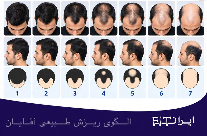 الگوی ریزش آقایان