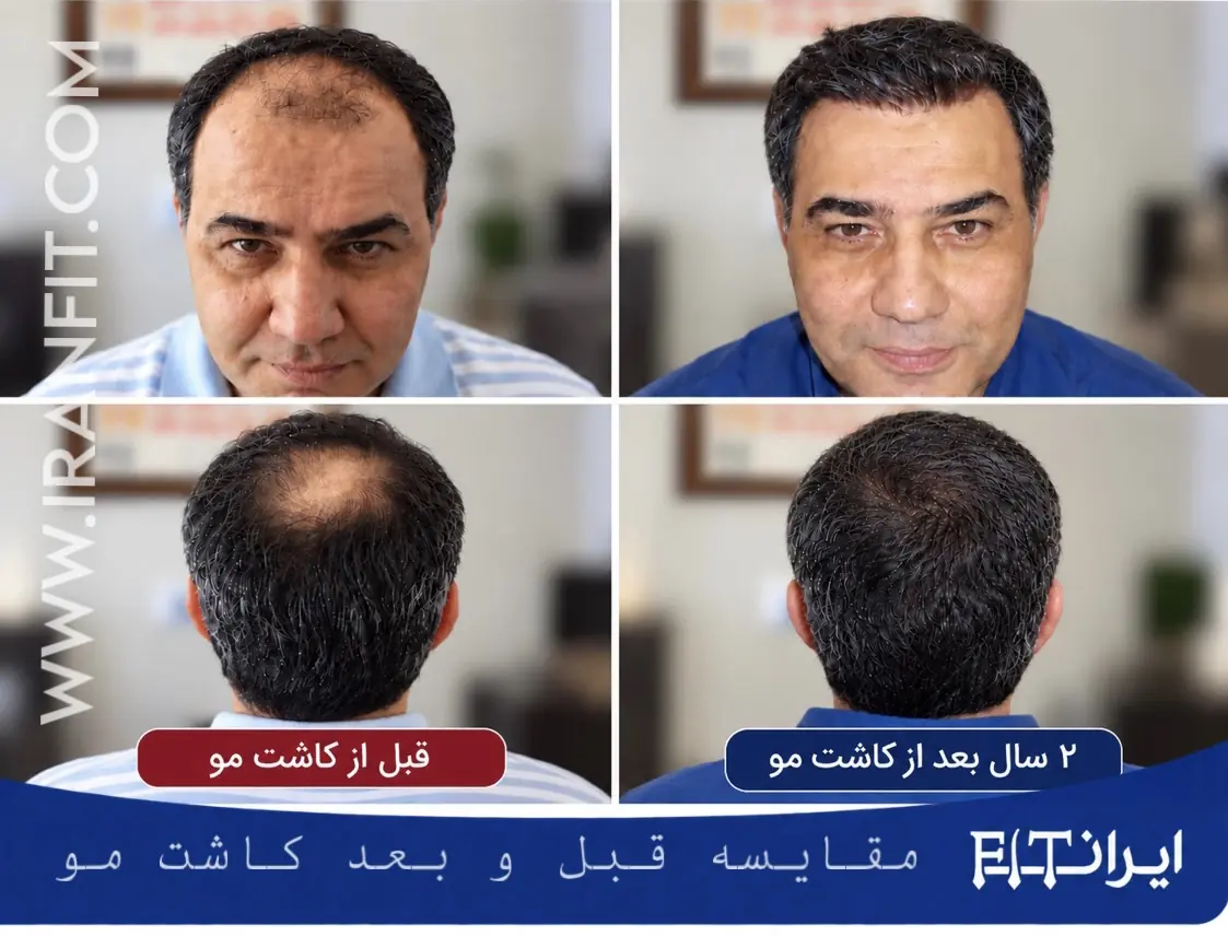 مقایسه قبل و بعد از کاشت مو