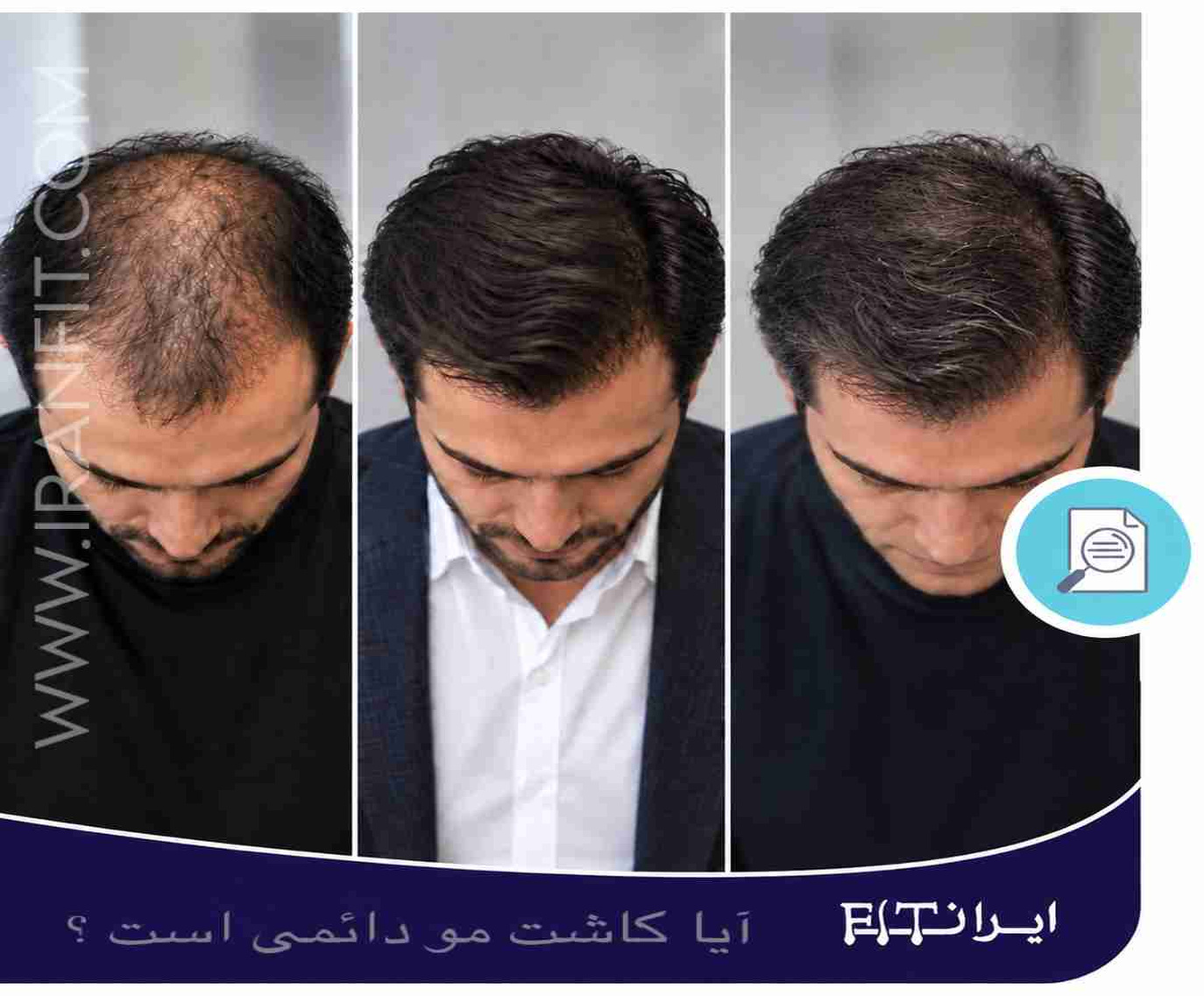 ماندگاری کاشت مو