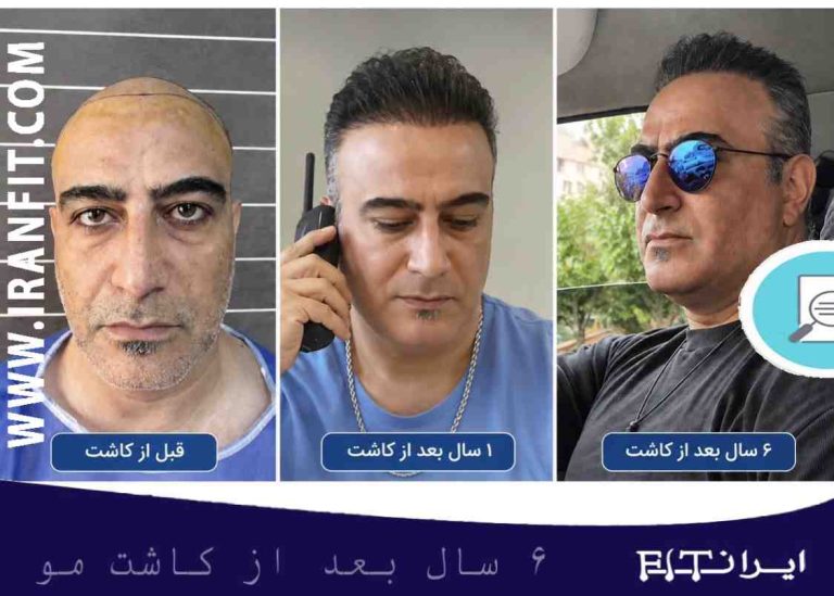 کاشت مو چند سال دوام دارد ؟ نتیجه کاشت مو بعد از 6 سال
