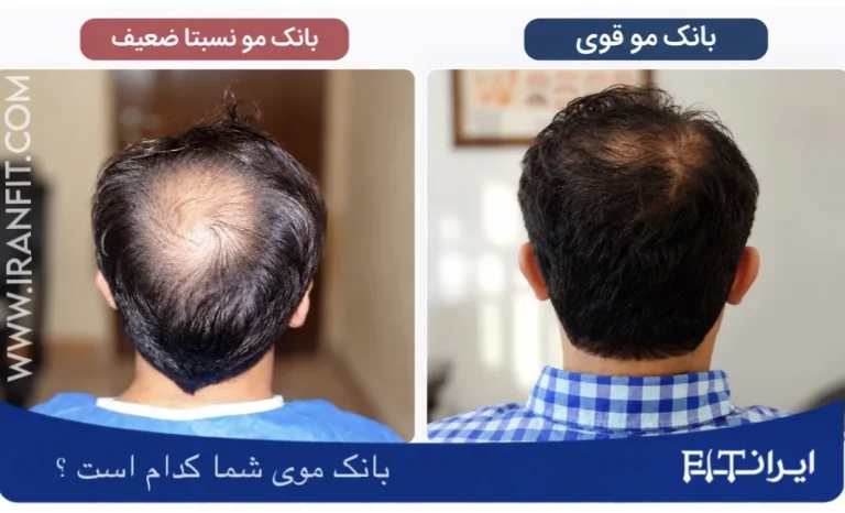 مقایسه بانک مو قوی و نستیا ضعیف در دو نفر
