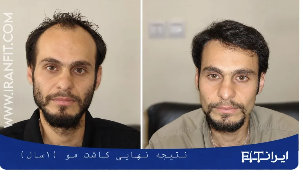نتیجه کاشت مو بعد از یکسال
