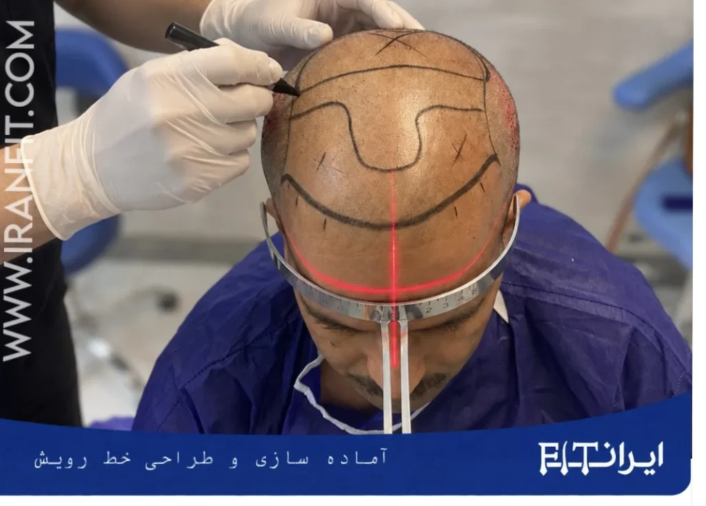 زمان طراحی خط رویش کاشت مو